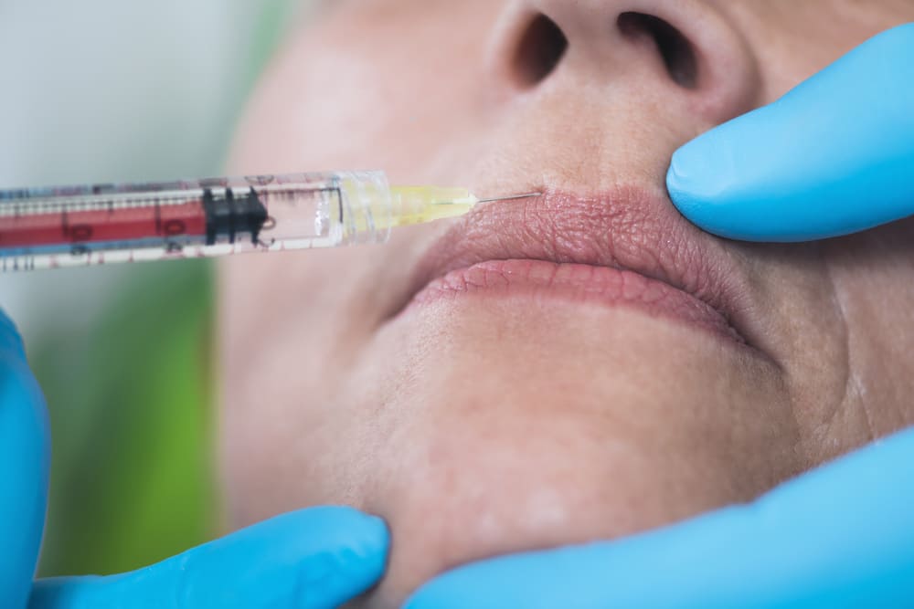 fillers aanbregen in de lip